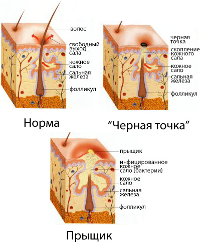 image001 1 - Прыщи у взрослых: причины появления акне