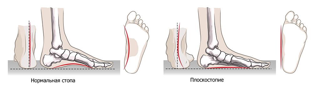 плоскостопие